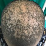 Alopecia Areata | Tibot