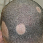 Alopecia_Areata