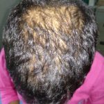 Alopecia_Pattern