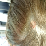 Alopecia_Scarring