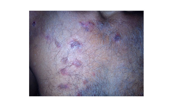 Lupus erythematosus on trunk