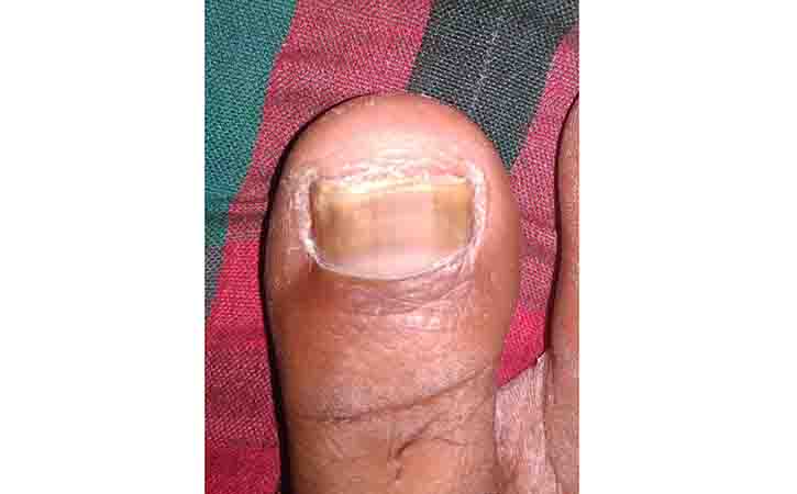 More of Onychomycosis