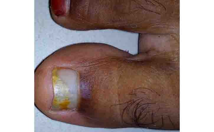 Onychomycosis Also Known As Tinea Unguium Is A Fungal Infection Of