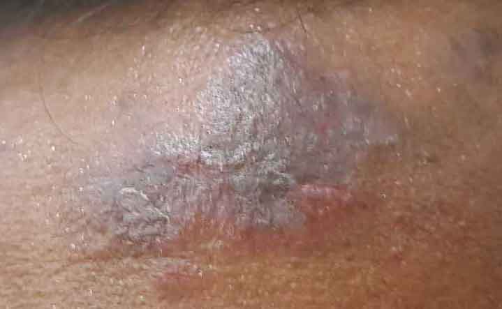Lupus is a Serious Skin Disease Which We Know a Little