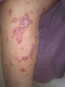 Plaque Psoriasis on Legs