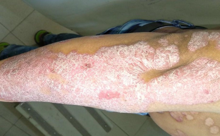 Psoriasis Treatment