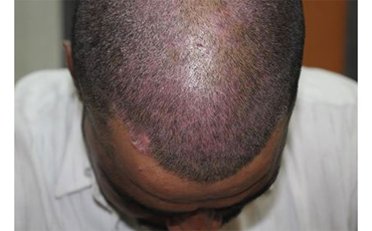 Scalp Psoriasis picture