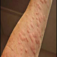 Red wheal caused due to Hives