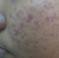 Red Spots On The Skin Find Out The Common Causes Tibot