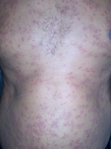 Guttate Psoriasis on the Trunk and Body