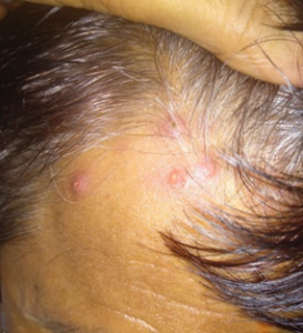 Red bumps on hair follicle due to Follucilitis