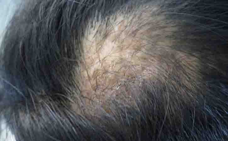 picture of scarring alopecia