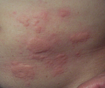 itchy skin hives