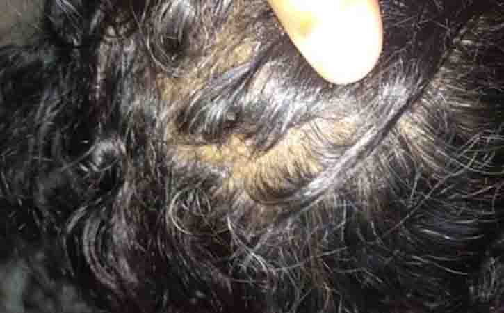 telogen alopecia