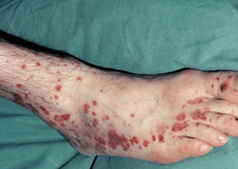 Vasculitis on Legs