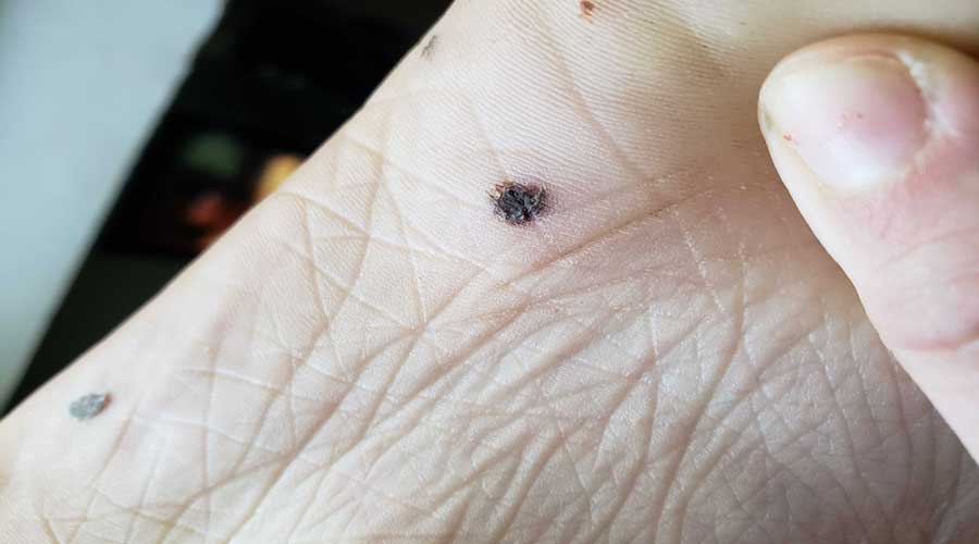 Black Warts On Hands