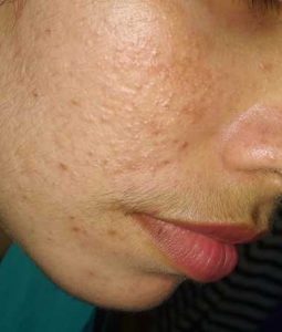 mild acne vulgaris