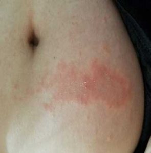 Common skin rashes to know, Home remedies and treatment