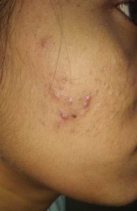 Home remedies and treatment of Moderate Acne