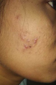 mild acne vulgaris