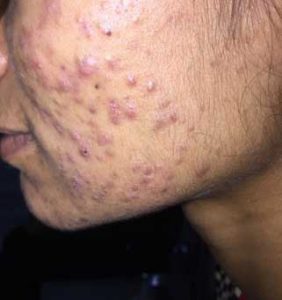 Treatment for Severe Acne