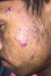 Treatment in Grade 4 Acne