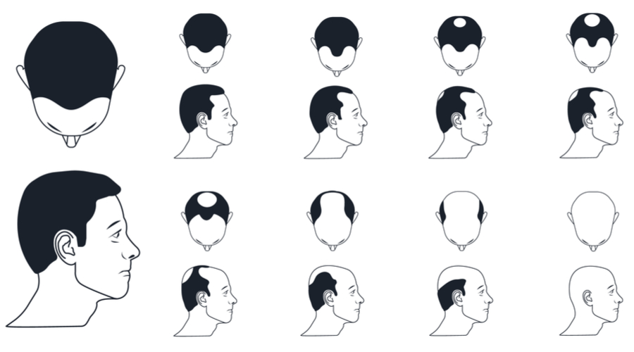 Different Types Of Hair Loss And It S Treatment Tibot