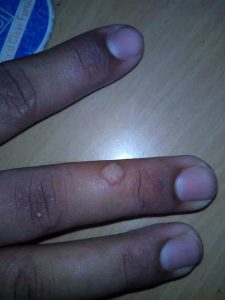 Warts on finger