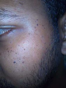 skin warts on face causes