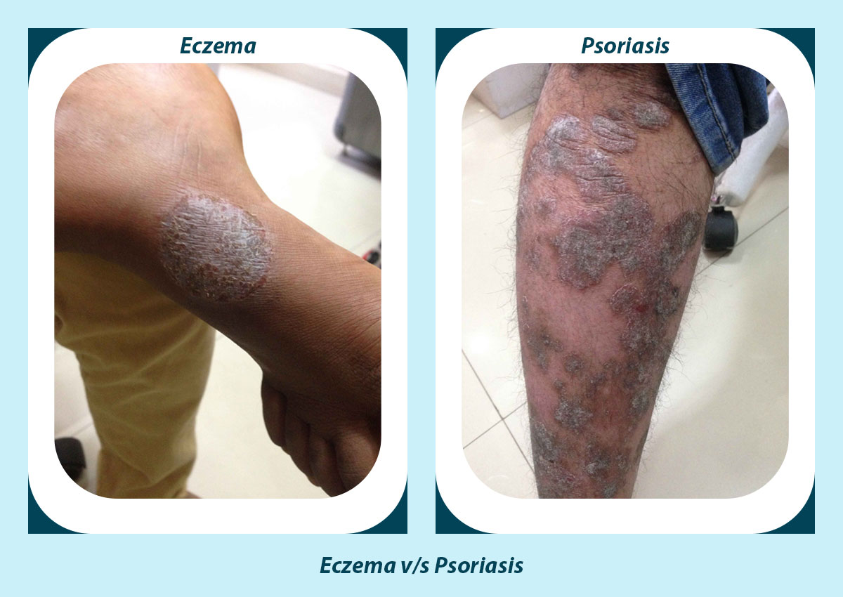 Eczema Vs Psoriasis 