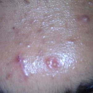 Little Bumps On Skin Skin Disorders Causing Little Bumps Tibot