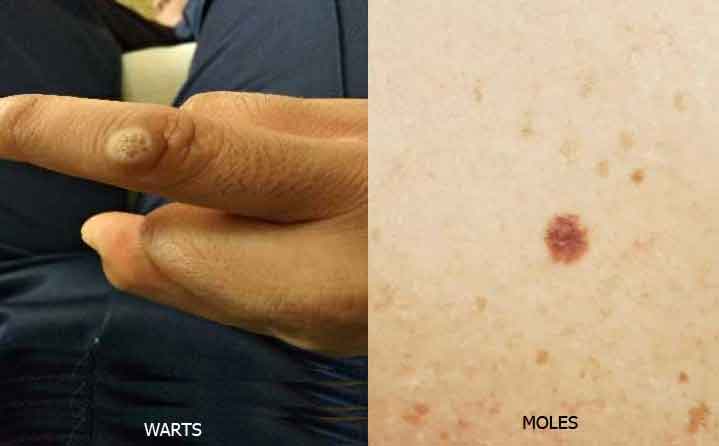 Warts Vs Moles