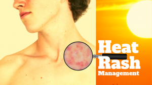 Heat Rash (Miliaria) – Causes and Management | Tibot