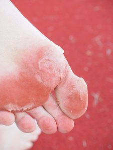 Foot disease