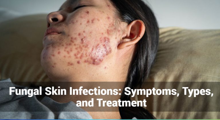 fungal-skin-infections-symptoms-types-and-treatment-tibot