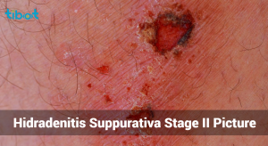 Hidradenitis Suppurativa Stage II Picture