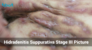 Hidradenitis Suppurativa Stage III Picture