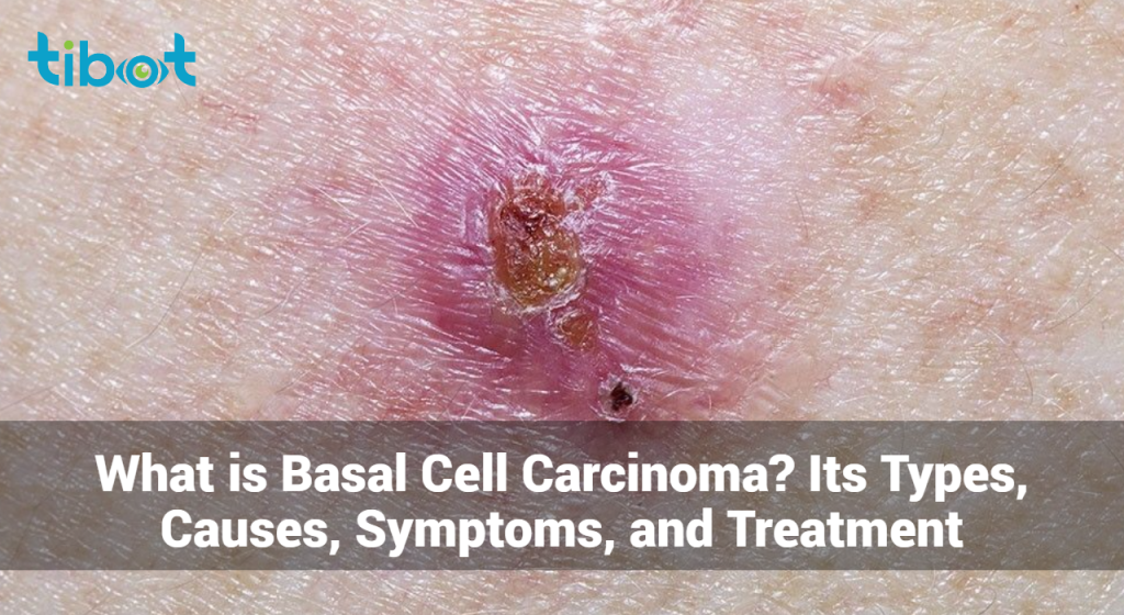 What is Basal Cell Carcinoma? Its Types, Causes, & Treatment