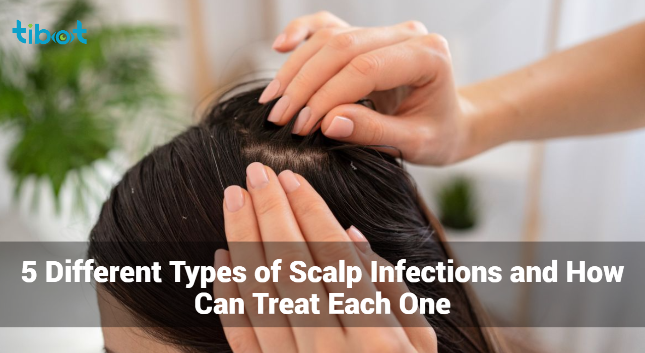 Types-of-Scalp-Infections