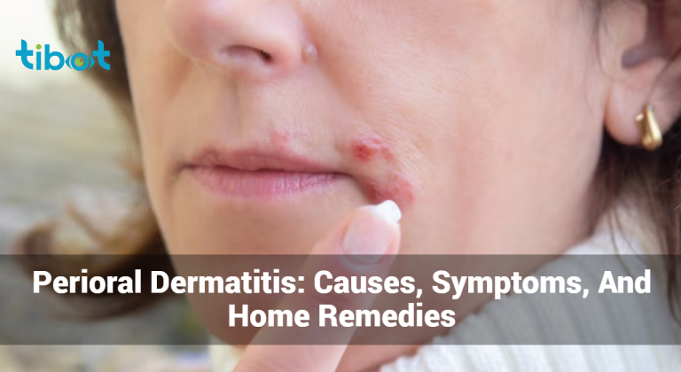 Perioral Dermatitis: Causes, Symptoms, And Home Remedies