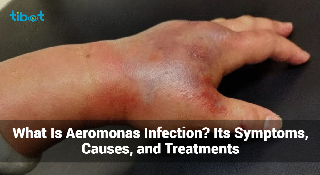 What Is Aeromonas Infection? - Symptoms, Causes & Treatments