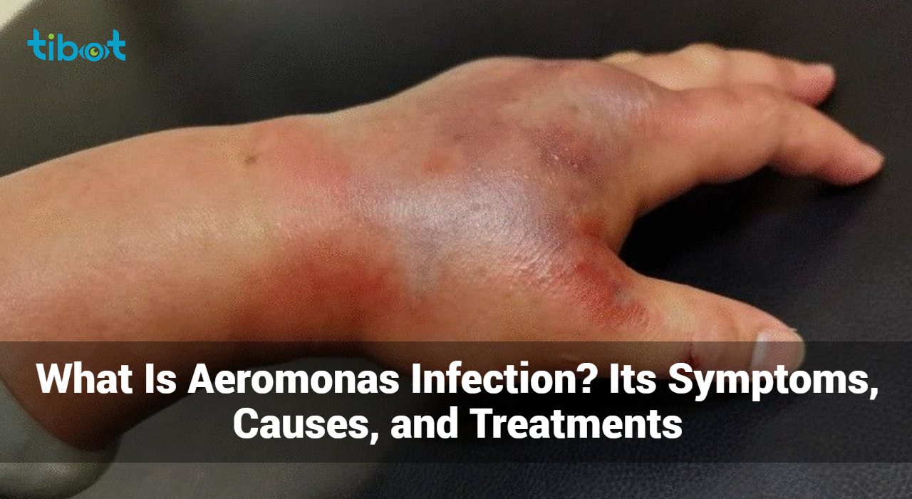 Aeromonas-Infection