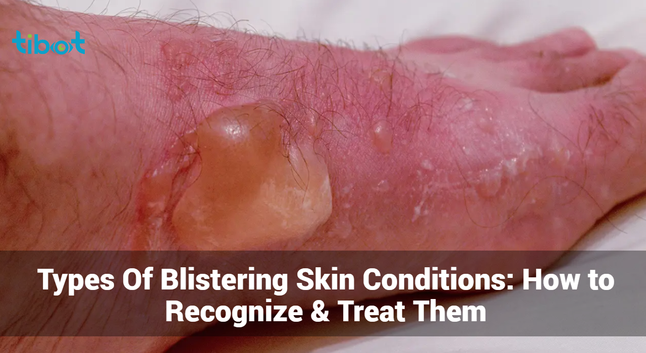 Blistering-Skin-Conditions