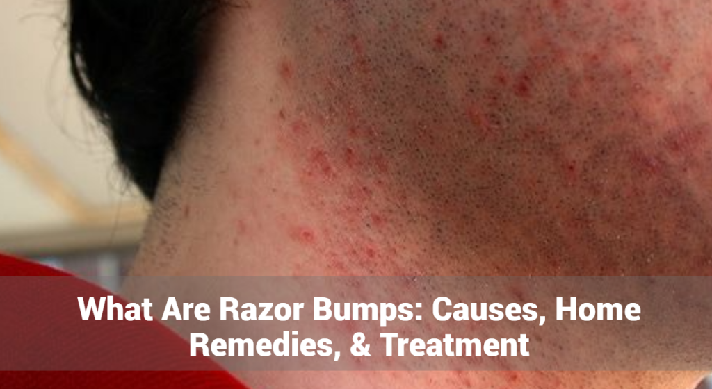 What Are Razor Bumps: Causes, Home Remedies, & Treatment