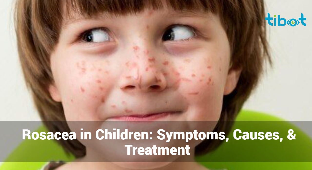 Rosacea-in-Children