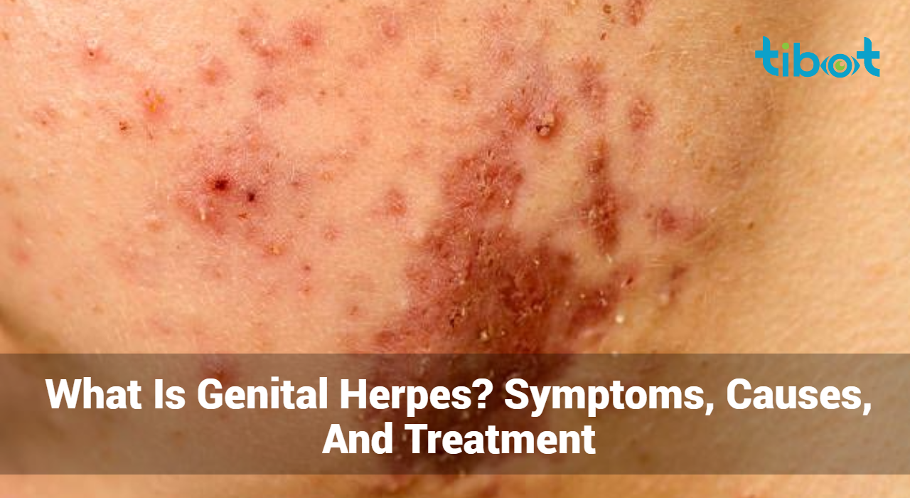 What-Is-Genital-Herpes