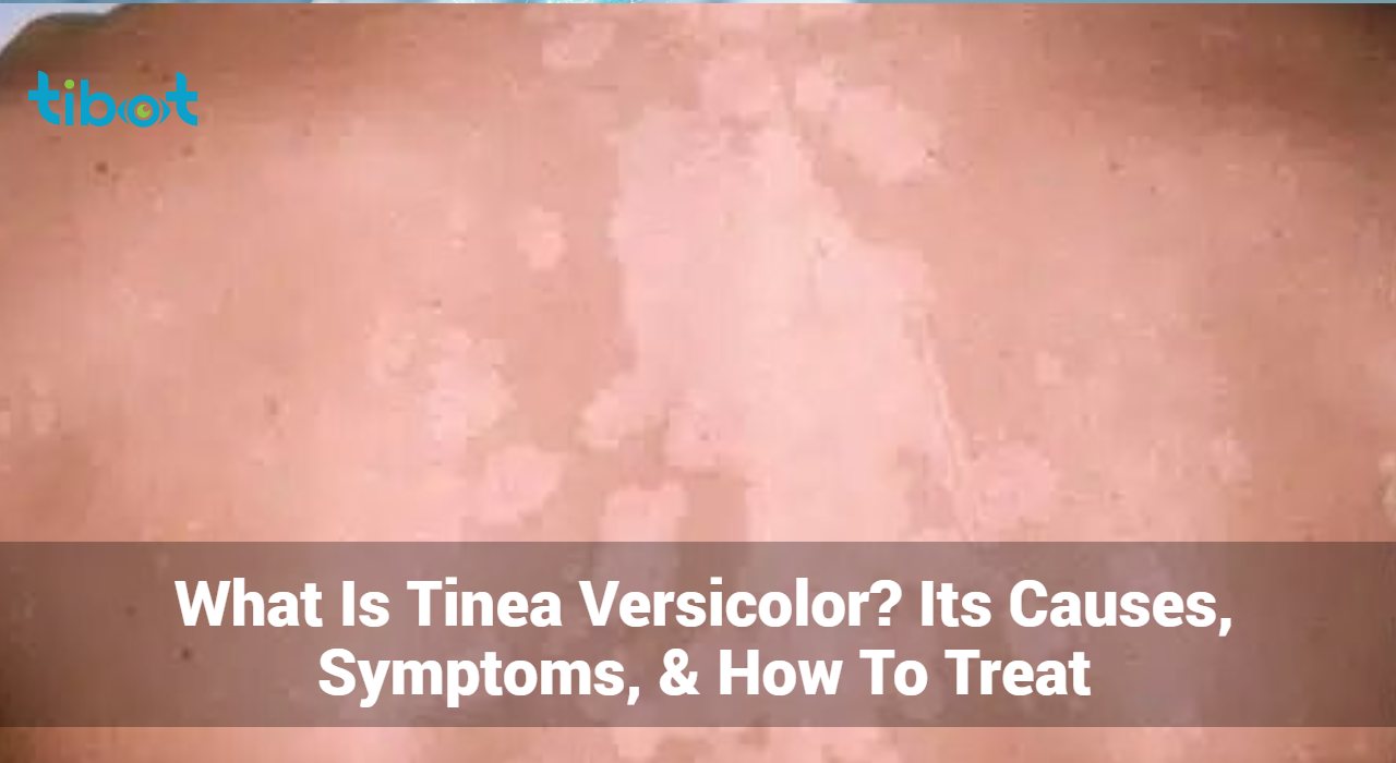 What-Is-Tinea-Versicolor