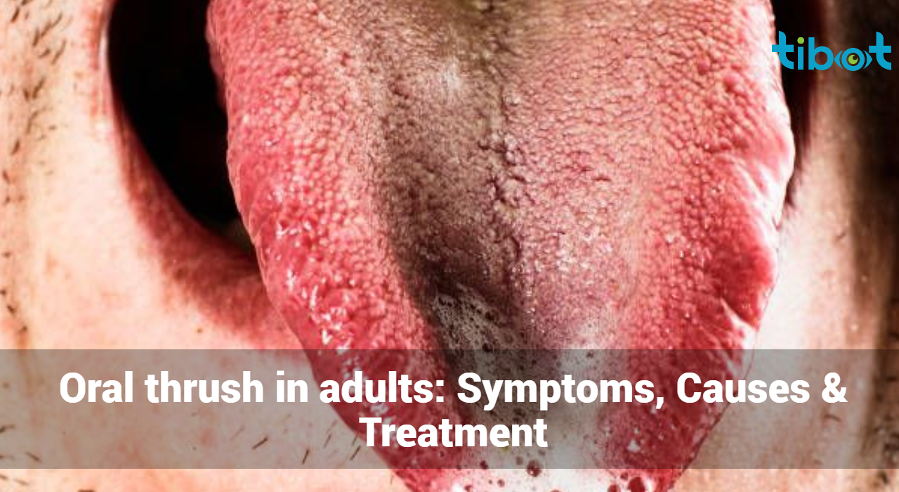 Oral-thrush-in-adults