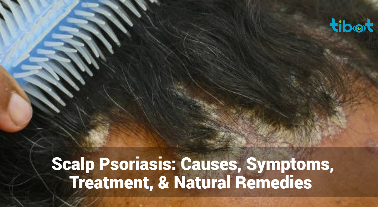 Scalp-Psoriasis