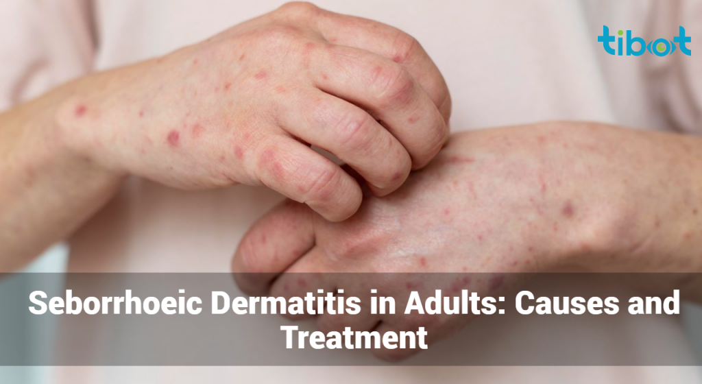 Seborrhoeic Dermatitis In Adults Causes And Treatment